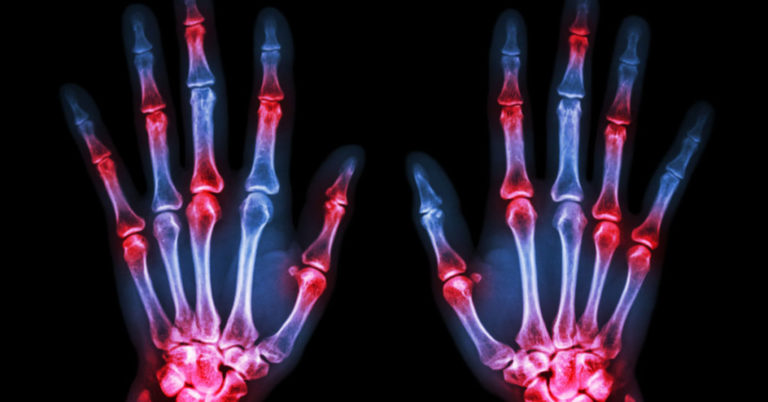 Arthritis Foundation Issues CBD Guidance For Adults With Arthritis